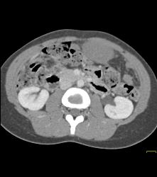 Desmoid Tumor - CTisus CT Scan