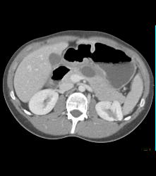 Desmoid Tumor - CTisus CT Scan