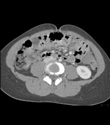 Desmoid Tumor - CTisus CT Scan