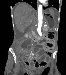 Carcinomatosis With Small Bowel Obstruction - CTisus CT Scan