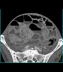 Carcinomatosis With Small Bowel Obstruction - CTisus CT Scan