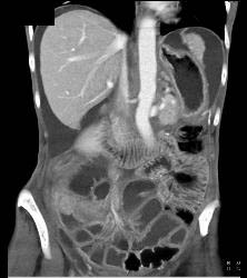 Carcinomatosis With Small Bowel Obstruction - CTisus CT Scan