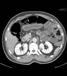 Lipoid Material in Small Bowel Used for Constipation - CTisus CT Scan