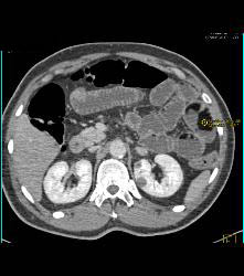 Lipoid Material in Small Bowel Used for Constipation - CTisus CT Scan