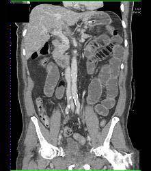 Lipoid Material in Small Bowel Used for Constipation - CTisus CT Scan