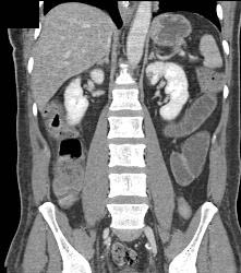 Lipoid Material in Small Bowel Used for Constipation - CTisus CT Scan