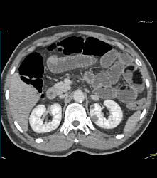 Lipoid Material in Small Bowel Used for Constipation - CTisus CT Scan