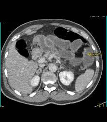 Lipoid Material in Small Bowel Used for Constipation - CTisus CT Scan