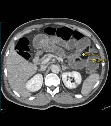 Lipoid Material in Small Bowel Used for Constipation - CTisus CT Scan