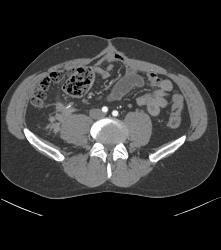 Recurrent Carcinoid Tumor in Right Lower Quadrant - CTisus CT Scan