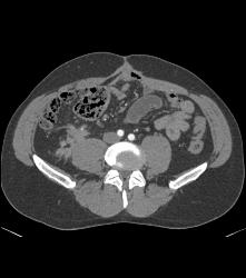 Recurrent Carcinoid Tumor in Right Lower Quadrant - CTisus CT Scan