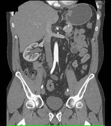 Recurrent Carcinoid Tumor in Right Lower Quadrant - CTisus CT Scan