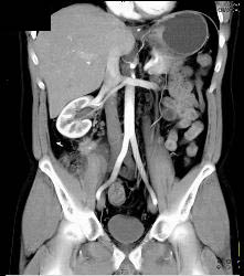 Recurrent Carcinoid Tumor in Right Lower Quadrant - CTisus CT Scan