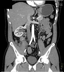 Recurrent Carcinoid Tumor in Right Lower Quadrant - CTisus CT Scan