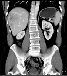 Recurrent Carcinoid Tumor in Right Lower Quadrant - CTisus CT Scan