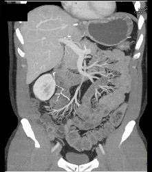 Recurrent Carcinoid Tumor in Right Lower Quadrant - CTisus CT Scan