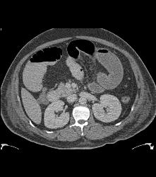 Ischemic Bowel With Subtle Clot in Distal SMA - CTisus CT Scan