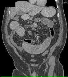 Ischemic Bowel With Subtle Clot in Distal SMA - CTisus CT Scan