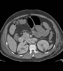 Ischemic Bowel With Subtle Clot in Distal SMA - CTisus CT Scan