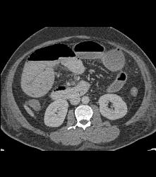 Ischemic Bowel With Subtle Clot in Distal SMA - CTisus CT Scan