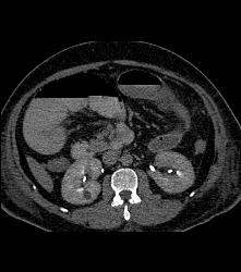 Ischemic Bowel With Subtle Clot in Distal SMA - CTisus CT Scan