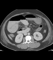 Ischemic Bowel With Subtle Clot in Distal SMA - CTisus CT Scan