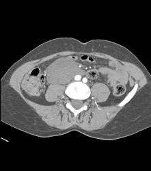 Desmoid Tumor - CTisus CT Scan