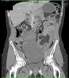 Desmoid Tumor - CTisus CT Scan