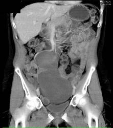 Desmoid Tumor - CTisus CT Scan