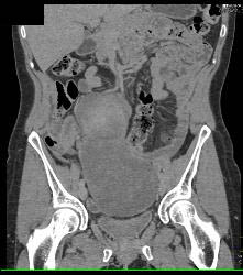 Desmoid Tumor - CTisus CT Scan