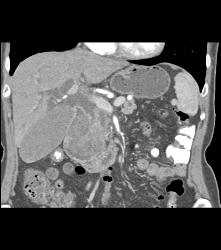 GIST Tumor Duodenum - CTisus CT Scan