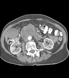 GIST Tumor Duodenum - CTisus CT Scan