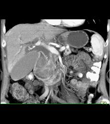 GIST Tumor Duodenum - CTisus CT Scan