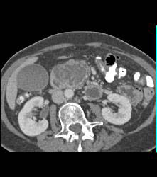 GIST Tumor Duodenum - CTisus CT Scan