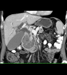 GIST Tumor Duodenum - CTisus CT Scan