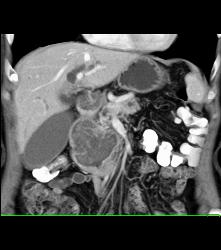 GIST Tumor Duodenum - CTisus CT Scan