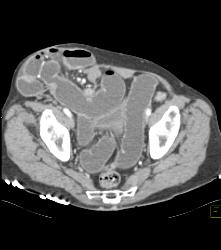 Small Bowel Obstruction (SBO) Due to Incisional Hernia - CTisus CT Scan