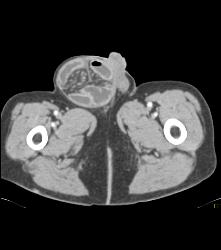 Small Bowel Obstruction (SBO) Due to Incisional Hernia - CTisus CT Scan