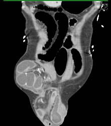 Small Bowel Obstruction (SBO) Due to Incisional Hernia - CTisus CT Scan