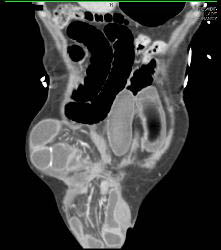 Small Bowel Obstruction (SBO) Due to Incisional Hernia - CTisus CT Scan