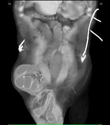 Small Bowel Obstruction (SBO) Due to Incisional Hernia - CTisus CT Scan