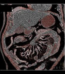 Carcinoid Tumor and Desmoplastic Reaction - CTisus CT Scan