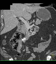 Carcinoid Tumor and Desmoplastic Reaction - CTisus CT Scan