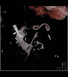 Stent in Duodenum Due to Obstruction - CTisus CT Scan