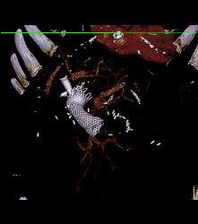 Stent in Duodenum Due to Obstruction - CTisus CT Scan