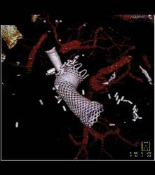 Stent in Duodenum Due to Obstruction - CTisus CT Scan