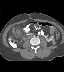 Acute Appendicitis and Ovarian Cyst - CTisus CT Scan