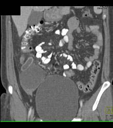 Acute Appendicitis and Ovarian Cyst - CTisus CT Scan