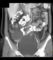 Acute Appendicitis and Ovarian Cyst - CTisus CT Scan