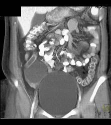 Acute Appendicitis and Ovarian Cyst - CTisus CT Scan